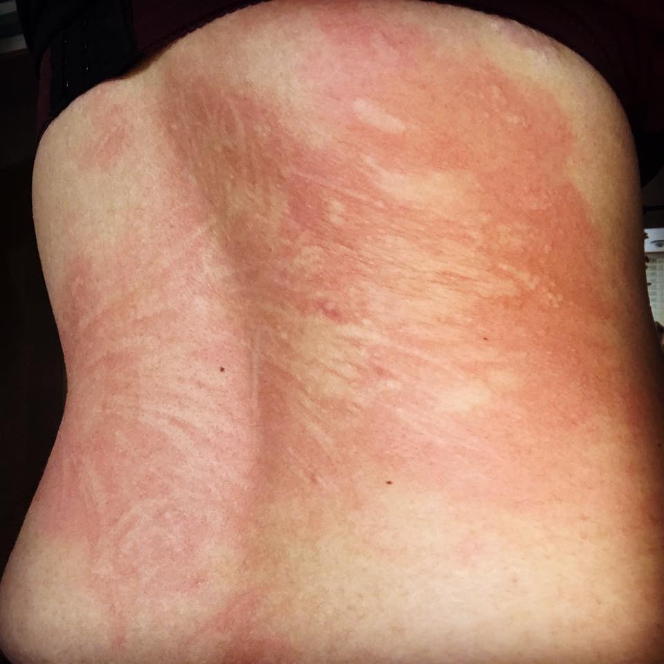 dermatographia example photo on a man's back